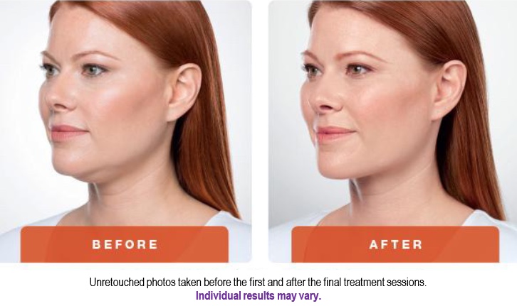 Kybella_Before&After